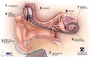 Esquema de un implante coclear